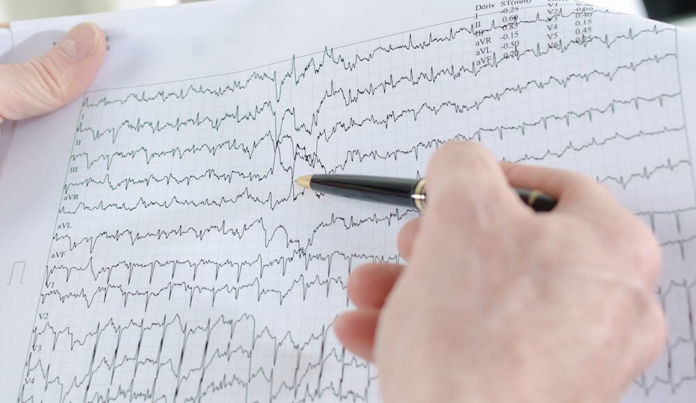 Læs mere om EKG. Alt du bør vide.